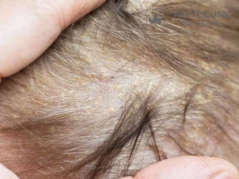 cách trị viêm da tiết bã cách trị viêm da tiết bã