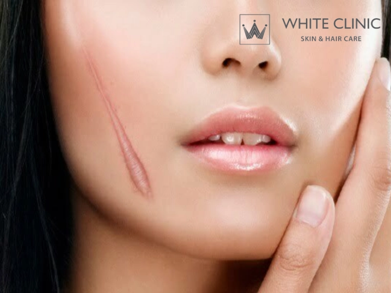 Điều Trị Sẹo Bỏng Bằng Laser Cơ Chế Tái Tạo Da Chuyên Sâu Hiệu Quả 