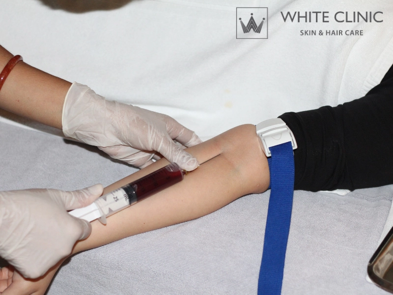 Lấy máu và chiết tách lấy PRP cải tiến