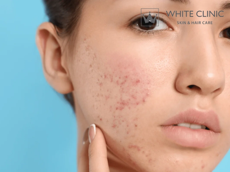 Trị Mờ Thâm Mụn: Hiểu Đúng Loại Thâm Để Chọn Phác Đồ Điều Trị Hiệu Quả 