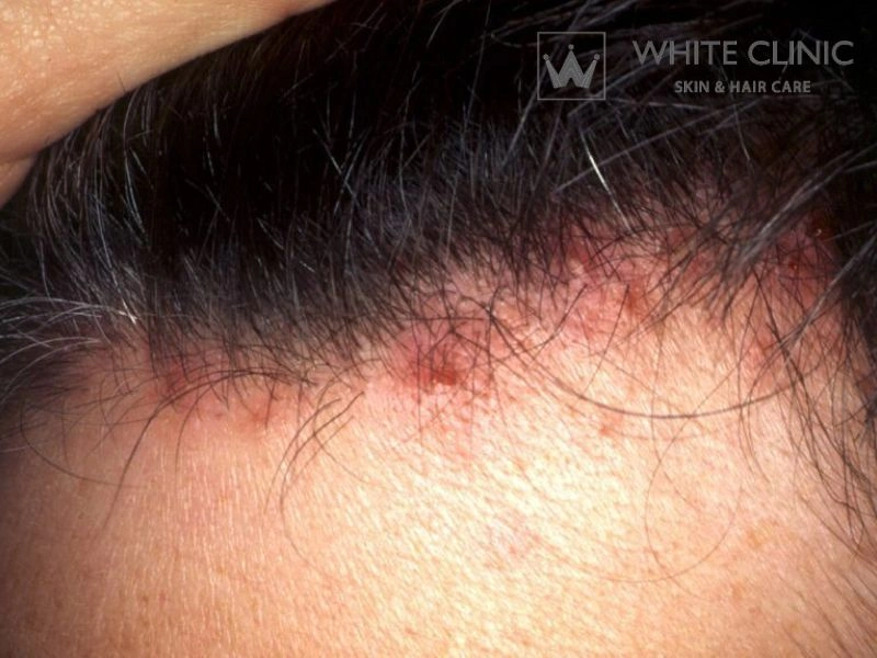 viêm nang lông da đầu