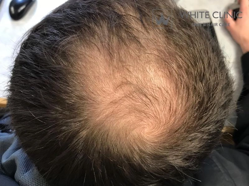 Dấu Hiệu Nhận Biết Hói Xoáy Tóc Và Giải Pháp Điều Trị Tại White Clinic 