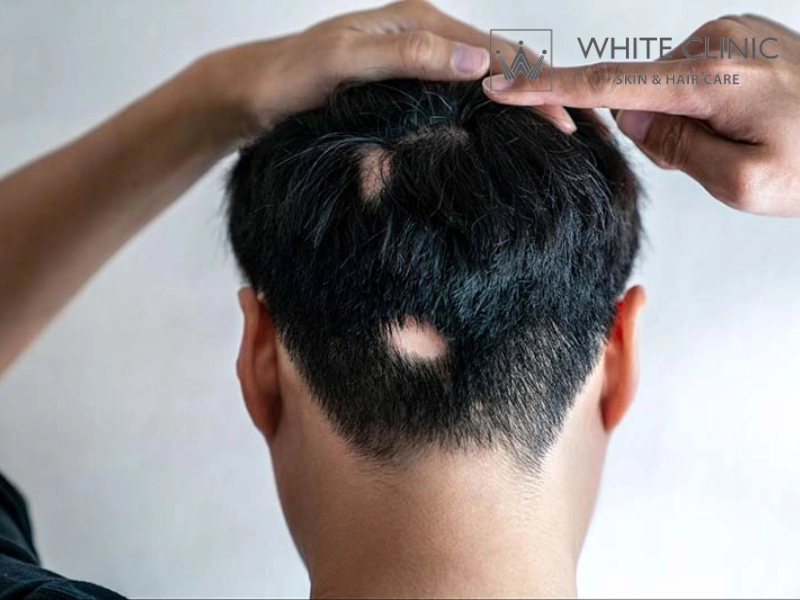 chữa rụng tóc nội tiết