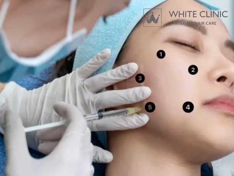 Tiêm Bap (Bio Aesthetic Points): Cơ Chế Phục Hồi Da Và Những Lưu Ý Về Độ An Toàn