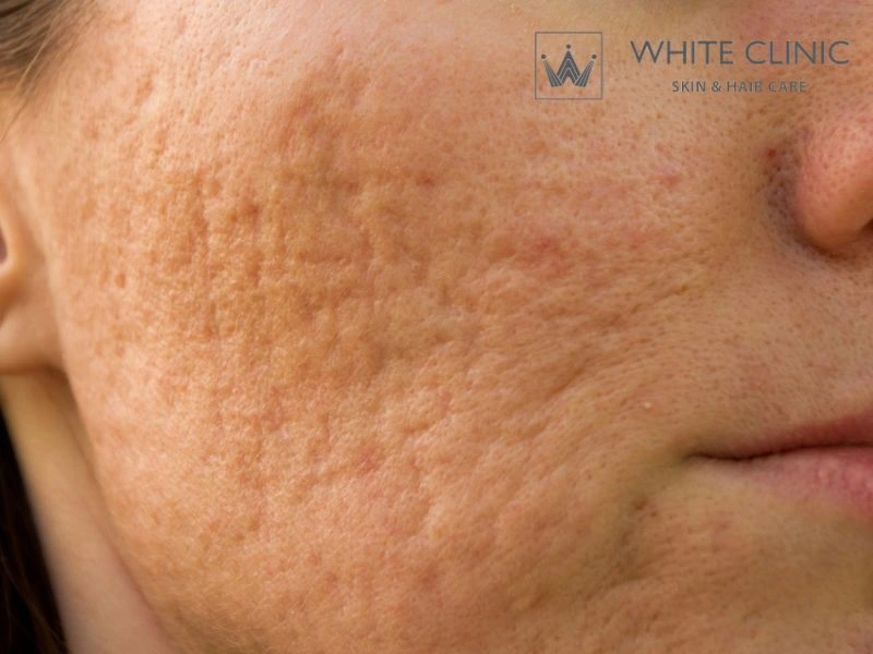 Sẹo Lượn Sóng (Rolling Scar): Cơ Chế & Phác Đồ Điều Trị Chuyên Sâu Tại White Clinic