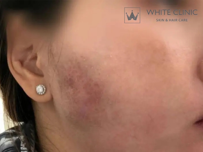 biến chứng tiêm filler