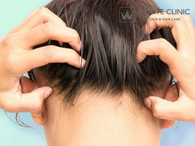 da đầu nhạy cảm da đầu nhạy cảm