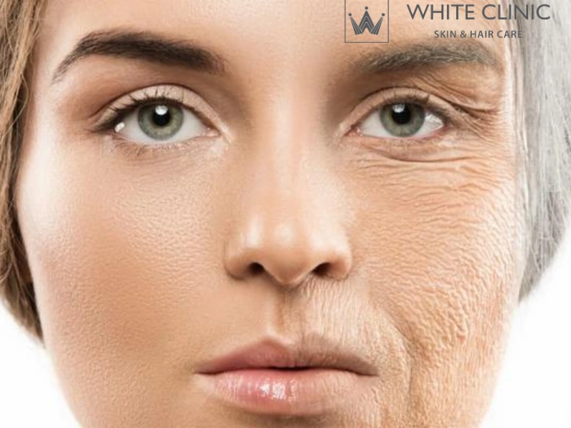 Xóa Nếp Nhắn Hiệu Quả Với Liệu Trình Glossy Skin Tại White Clinic