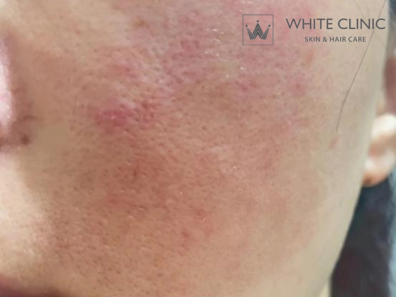 nguyên nhân gây nám mảng