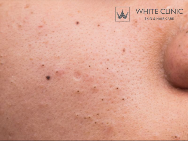 Phân Biệt Các Loại Mụn Thường Gặp Và Cách Điều Trị Hiệu Quả Tại White Clinic 
