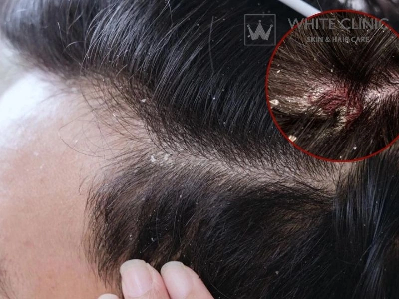 tác dụng phụ của thuốc mọc tóc