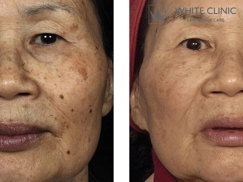 Công nghệ Micro Fraxel 