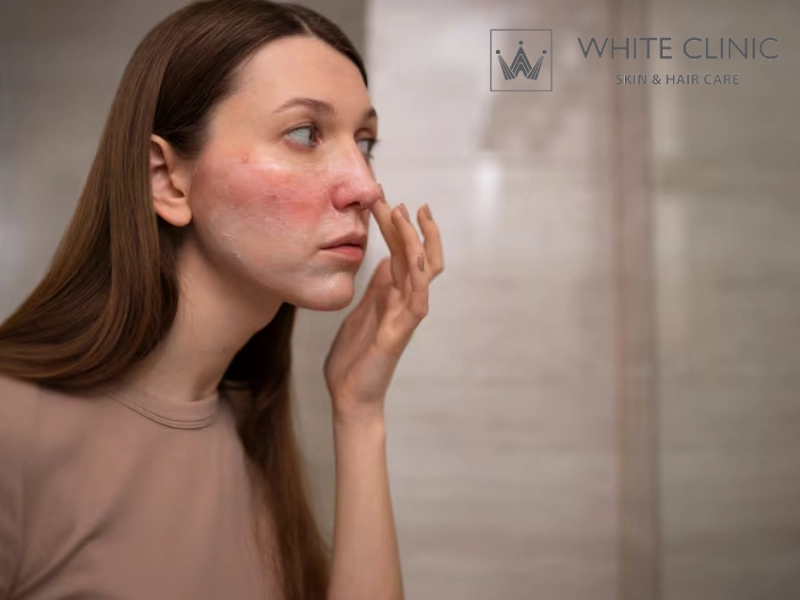 Bị Phỏng Có Để Lại Sẹo Không? Giải Pháp Laser Fractional CO2 Tái Tạo Da