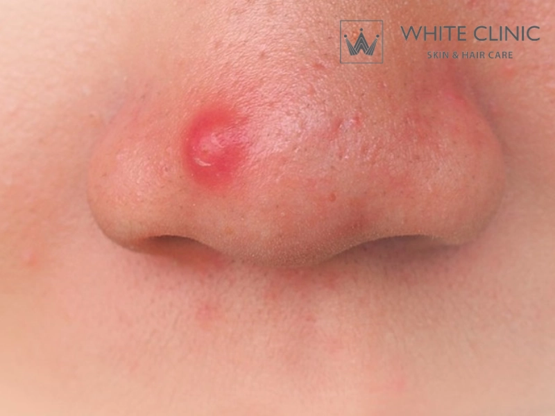 Mụn Bọc Là Gì? Dấu Hiệu, Nguyên Nhân Gây Mụn Và Cách Xử Lý 