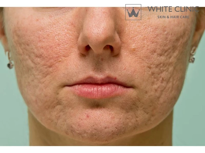 phương pháp trị sẹo rỗ phương pháp trị sẹo rỗ