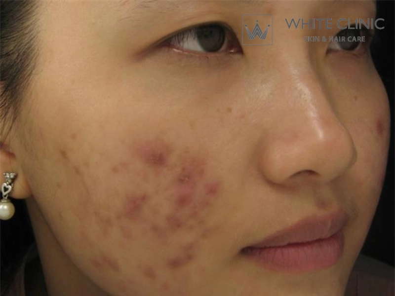 trị mụn bằng chanh