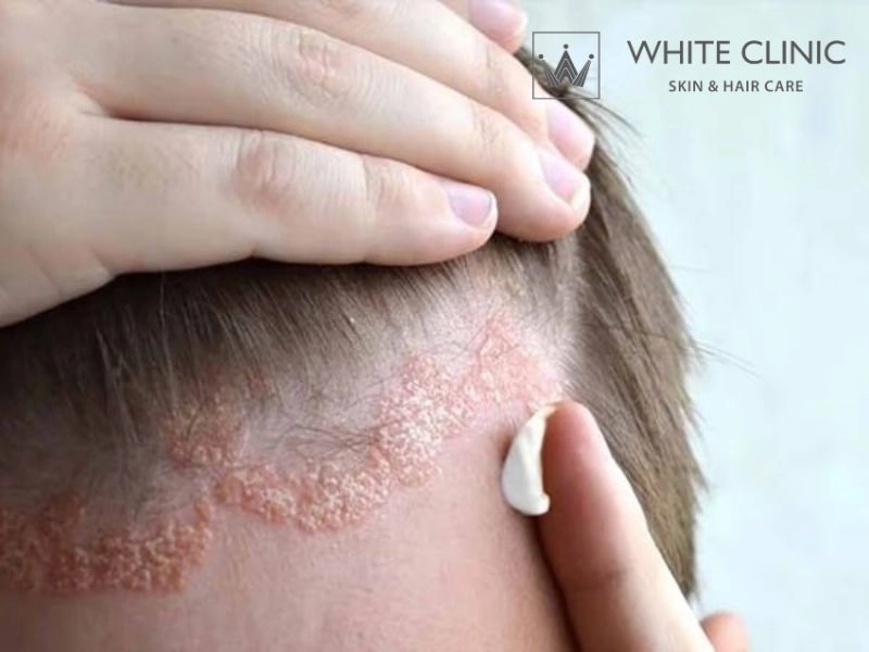 Điều trị viêm da tiết bã: Cách phân biệt và lộ trình kiểm soát tái phát