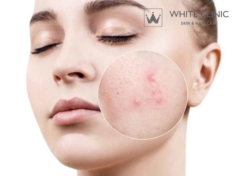 mụn đầu đen ở má