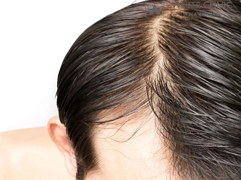 meso botox meso botox