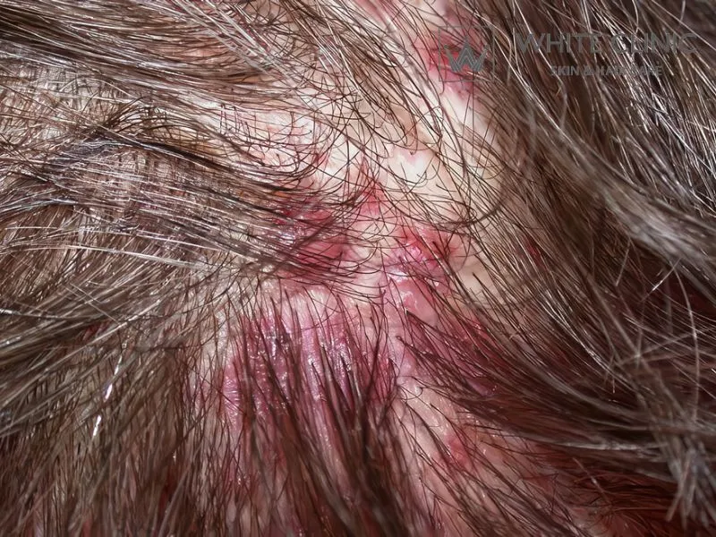 Da Đầu Bị Đỏ: Nguyên Nhân Gây Và Phương Pháp Điều Trị Hiệu Quả 