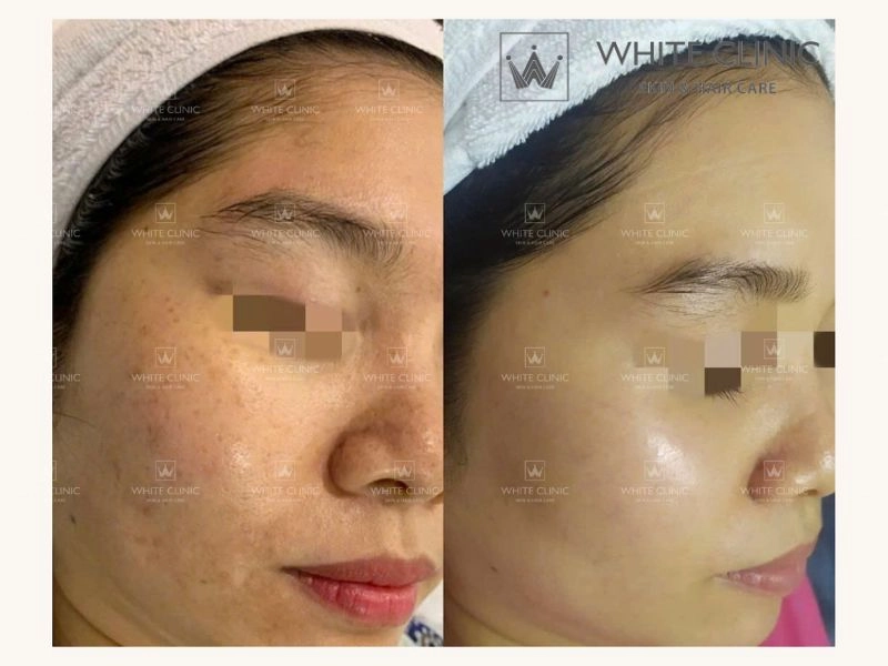 Ai nên cân nhắc điều trị bằng Laser Revlite