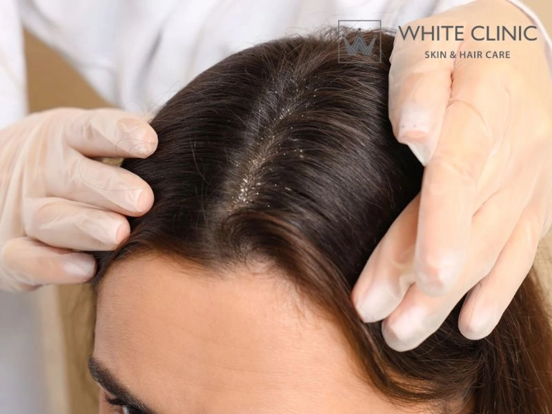 Những lưu ý quan trọng khi chăm sóc da đầu bị vảy nến tại nhà