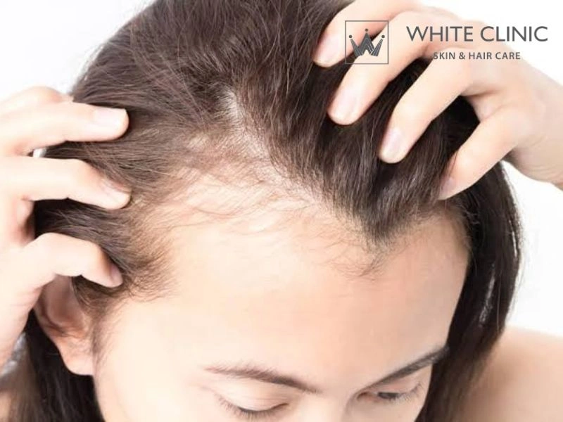tiêm mesotherapy mọc tóc tiêm mesotherapy mọc tóc