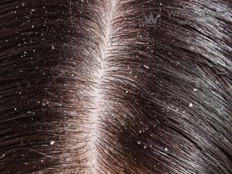 Ngứa da đầu, bong vảy và rụng tóc: Là gàu thông thường hay nấm da đầu?
