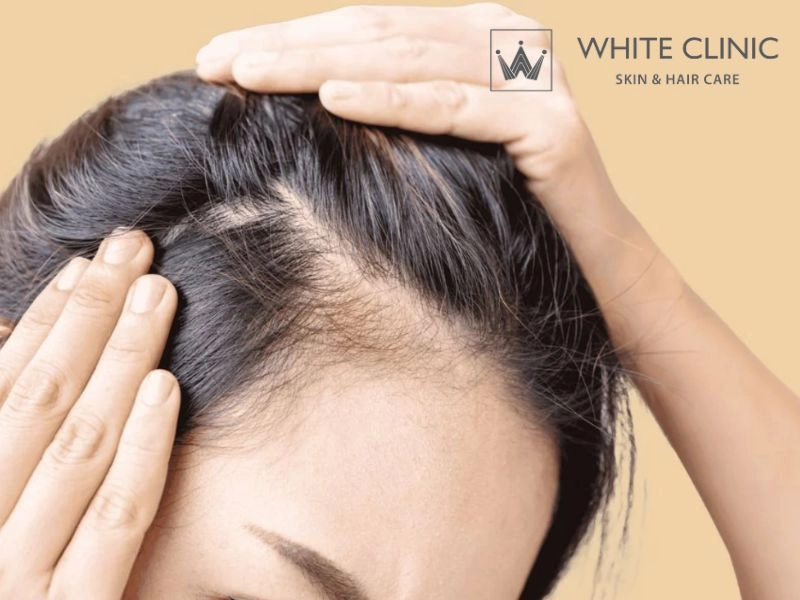 minoxidil trị rụng tóc minoxidil trị rụng tóc