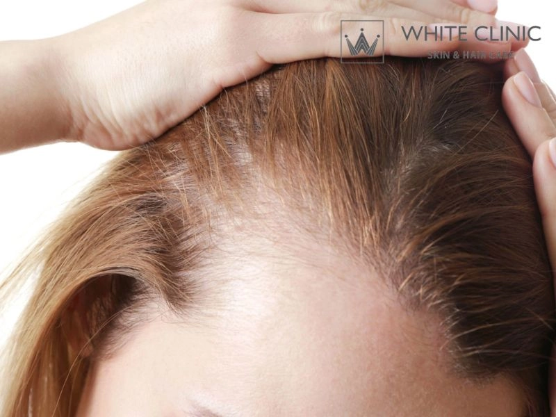 rụng tóc không sẹo