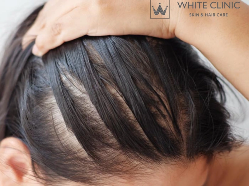Nguyên Nhân Gây Rụng Tóc Và Giải Pháp Phục Hồi Từ Gốc 