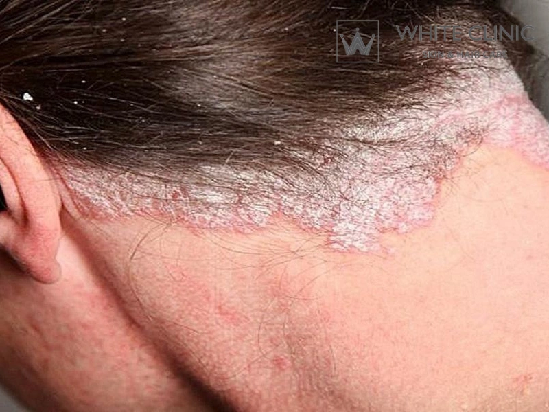 Viêm Da Tiết Bã Có Lây Không? Giải Đáp Từ Góc Nhìn Chuyên Gia