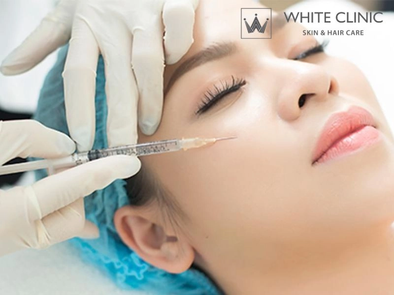 Tiêm filler Tiêm filler