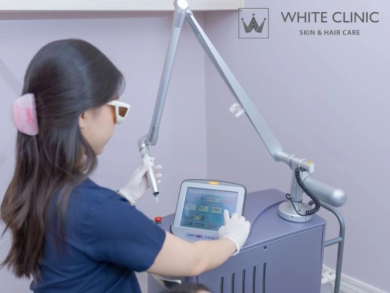 có nên bắn laser trị nám có nên bắn laser trị nám