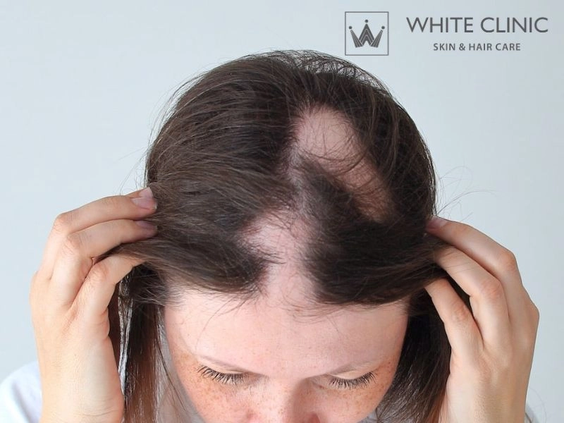 rụng tóc tự miễn