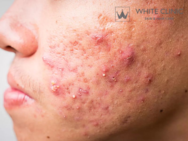 Mụn Viêm Là Gì? Nguyên Nhân Gây Nên Và Cách Xử Lý Hiệu Quả 