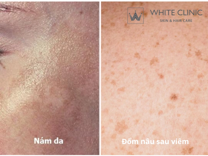 nguyên nhân gây nám da