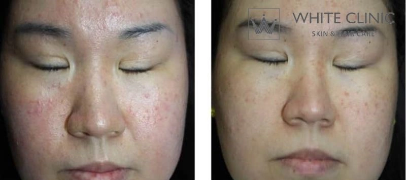 Trị sẹo rỗ hiệu quả với liệu trình MICRO FRAXEL tại White Clinic Trị sẹo rỗ hiệu quả với liệu trình MICRO FRAXEL tại White Clinic