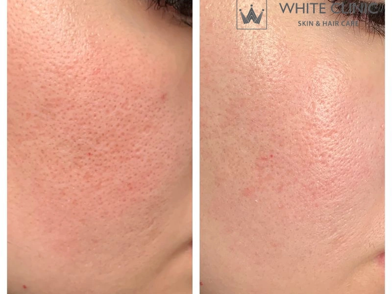 laser thu nhỏ lỗ chân lông laser thu nhỏ lỗ chân lông