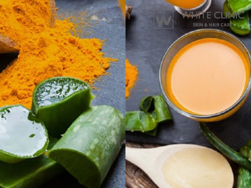 trị mụn bằng nha đam