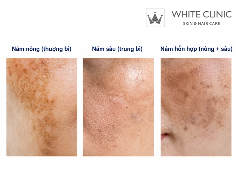 cách trị nám nội tiết cách trị nám nội tiết
