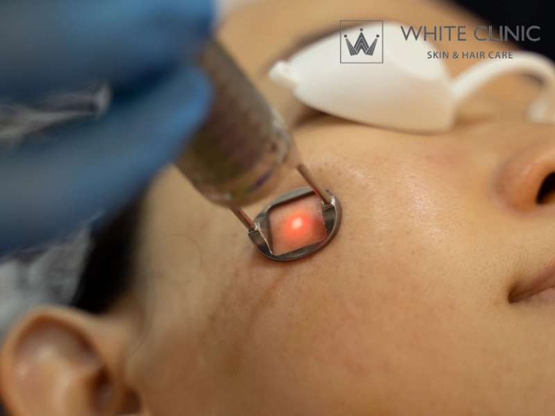 Có Nên Bắn Laser Trị Nám Không? Khi Nào Nên Lựa Chọn Sử Dụng Laser 