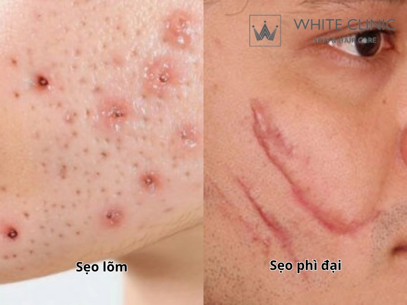 Sẹo lõm/Sẹo phì đại