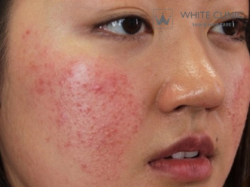 Giải mã các vùng bị mụn trên khuôn mặt: Nguyên nhân và hướng xử lý an toàn 