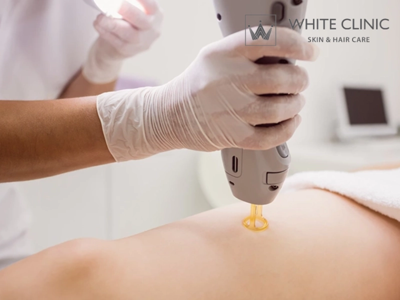 Tiêu chí chọn nơi điều trị sẹo lồi an toàn