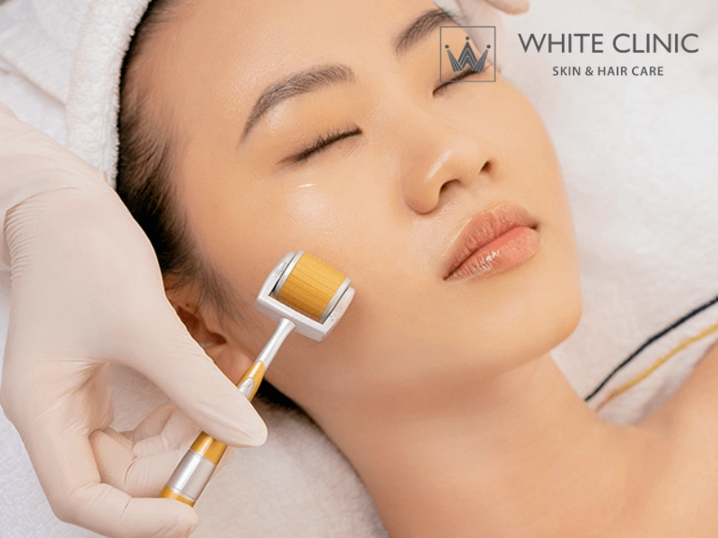 Lăn Kim Trị Sẹo Rỗ: Hiểu Đúng Cơ Chế, Phác Đồ Và Cách Tránh Biến Chứng