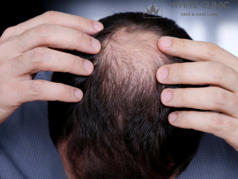 cách mọc tóc nhanh sau hóa trị