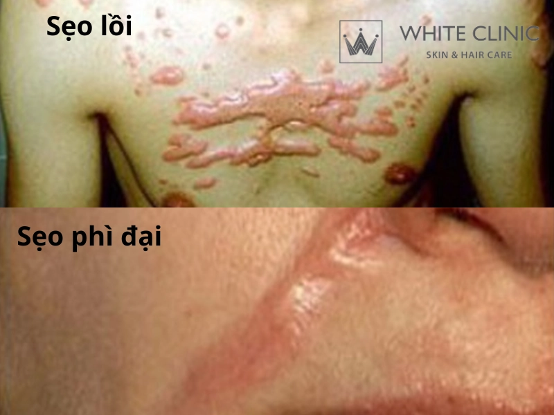 sẹo tai nạn sẹo tai nạn