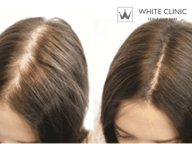 thuốc mọc tóc thuốc mọc tóc