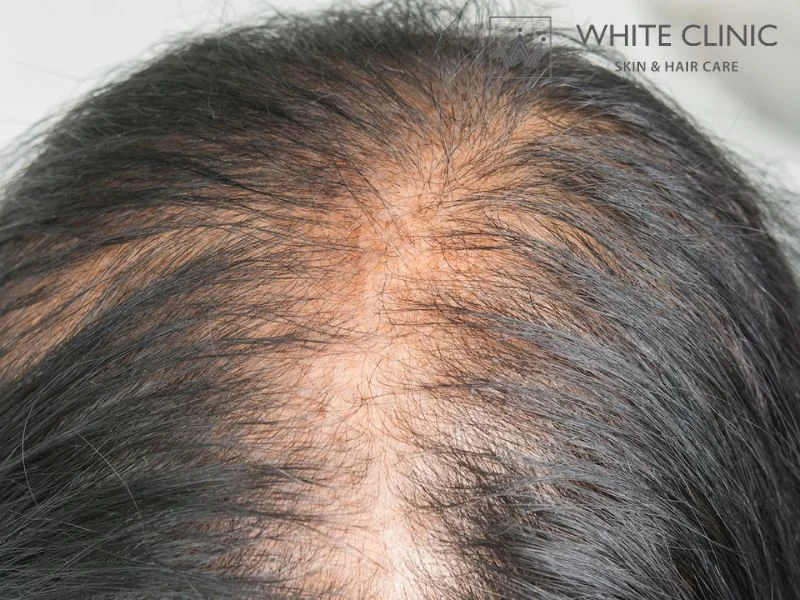 phục hồi nang tóc phục hồi nang tóc